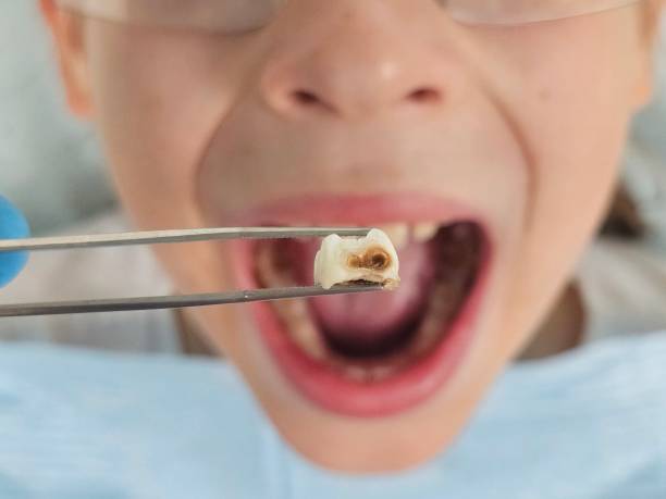 Best Pediatric Emergency Dentist in South Sarasota, FL
