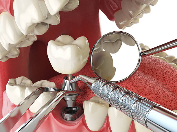 Best Emergency Dentist for Knocked-Out Tooth in South Sarasota, FL